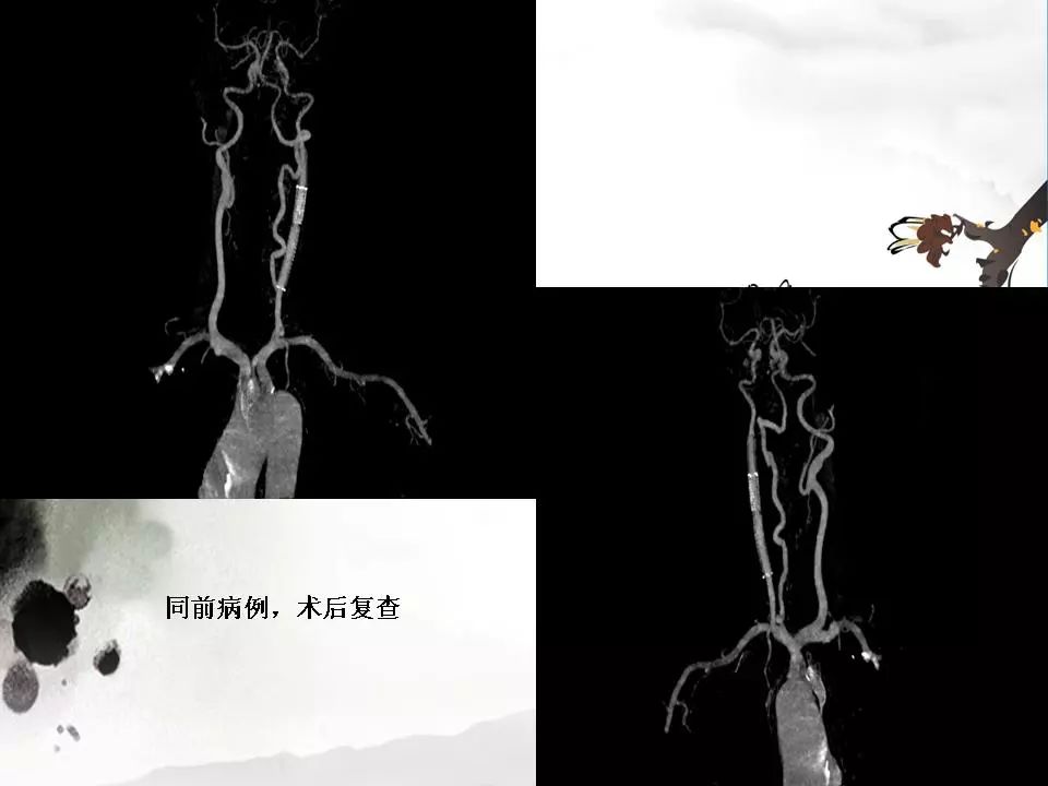 影像PPT - 【PPT】颈动脉CTA及MRA评价-28