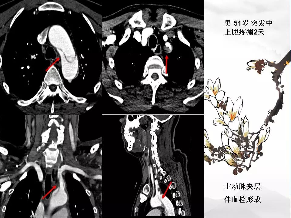 影像PPT - 【PPT】颈动脉CTA及MRA评价-31
