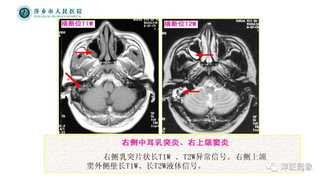 影像PPT - 【PPT】鼻/鼻窦病变影像诊断-9