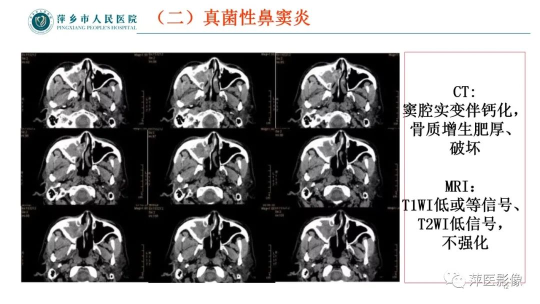 影像PPT - 【PPT】鼻/鼻窦病变影像诊断-12