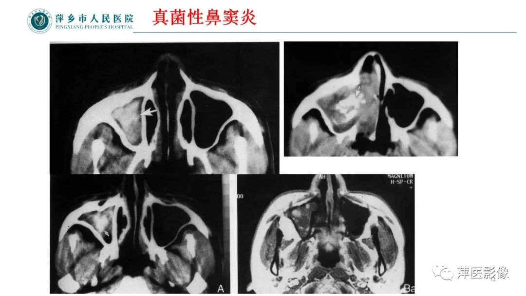 影像PPT - 【PPT】鼻/鼻窦病变影像诊断-13