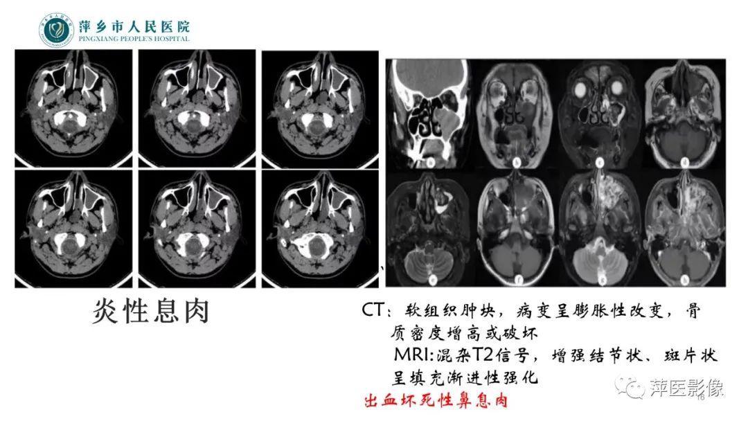 影像PPT - 【PPT】鼻/鼻窦病变影像诊断-16
