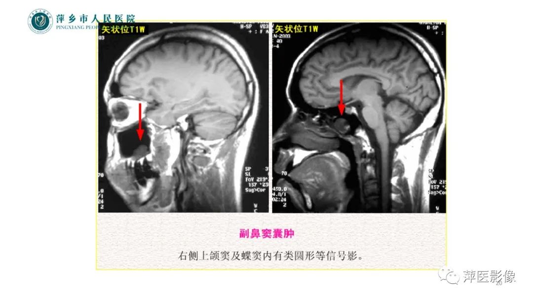 影像PPT - 【PPT】鼻/鼻窦病变影像诊断-20