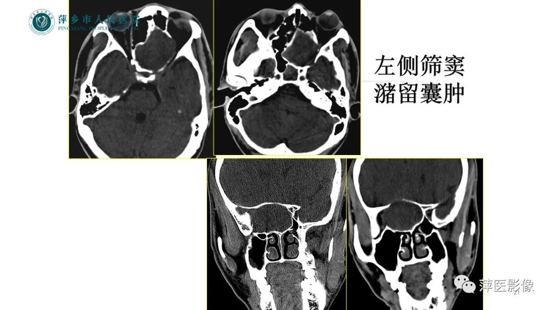 影像PPT - 【PPT】鼻/鼻窦病变影像诊断-21