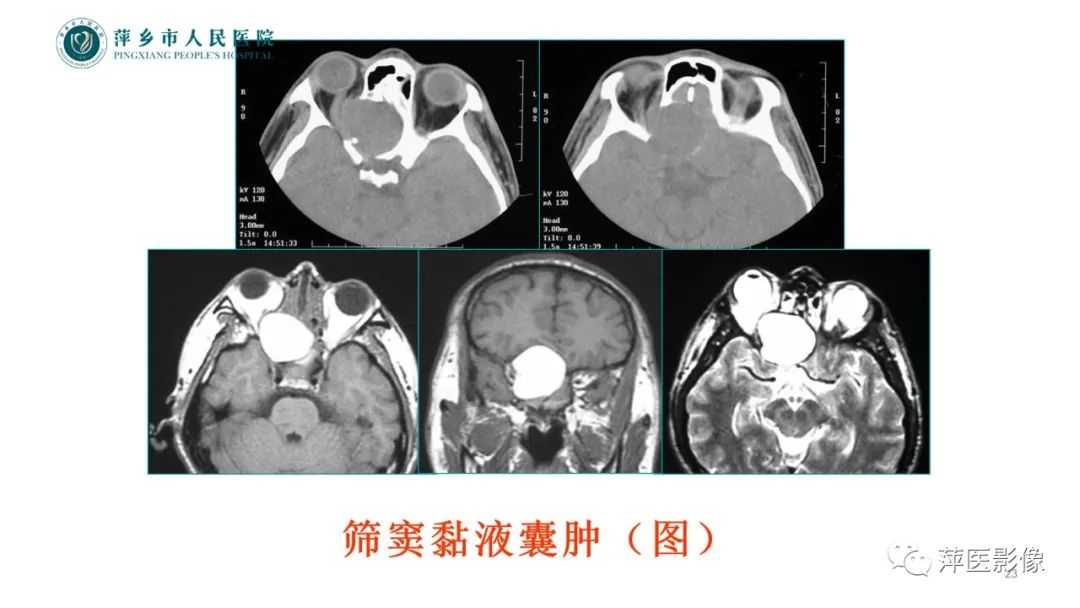 影像PPT - 【PPT】鼻/鼻窦病变影像诊断-23