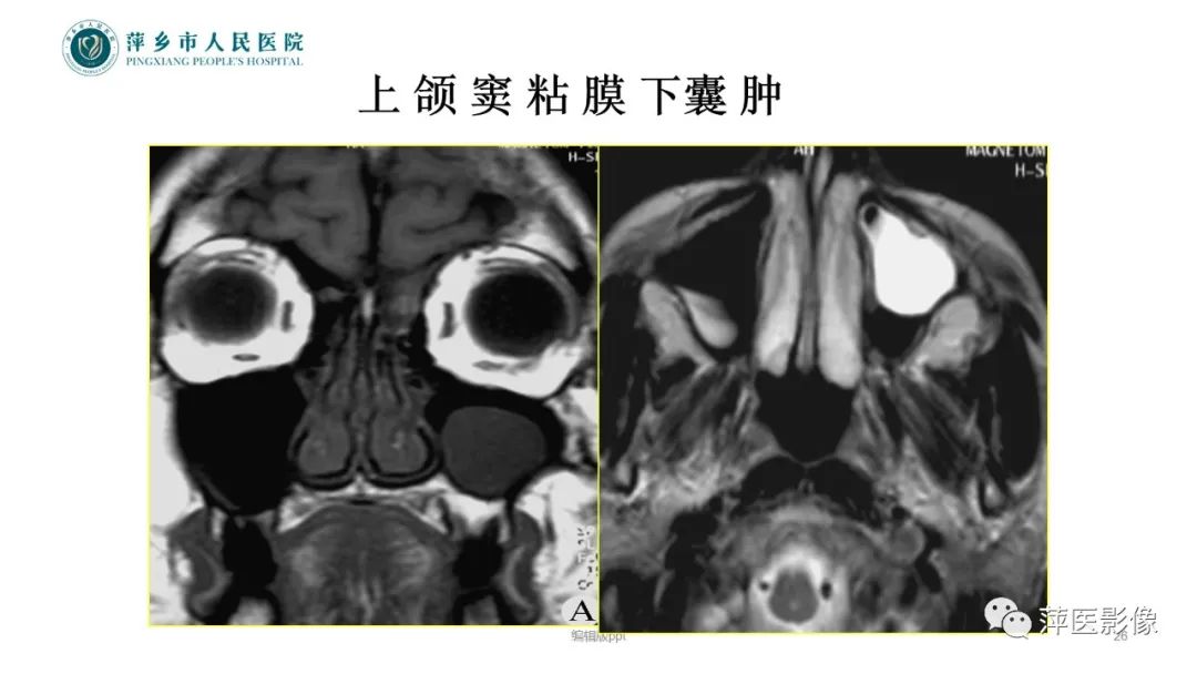 影像PPT - 【PPT】鼻/鼻窦病变影像诊断-26