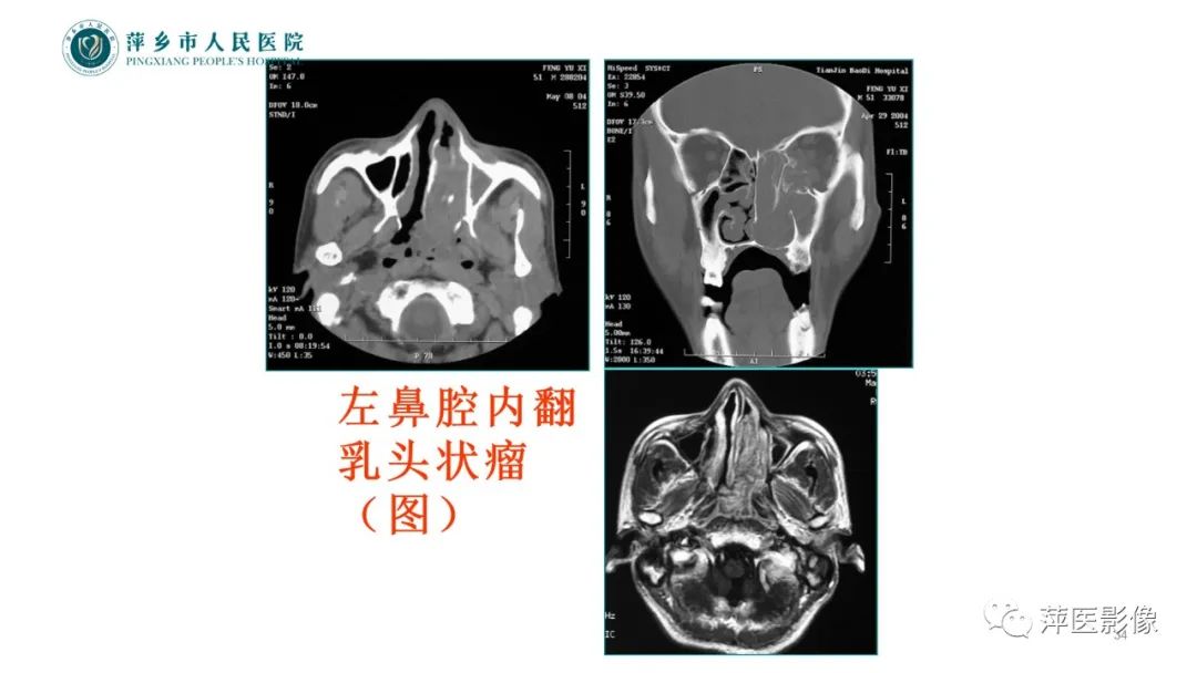 影像PPT - 【PPT】鼻/鼻窦病变影像诊断-34