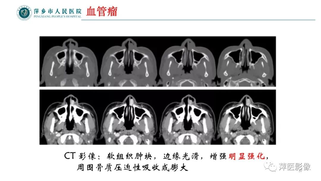 影像PPT - 【PPT】鼻/鼻窦病变影像诊断-37