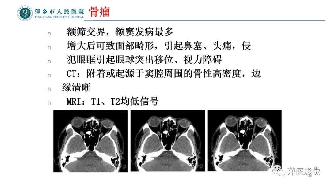 影像PPT - 【PPT】鼻/鼻窦病变影像诊断-38