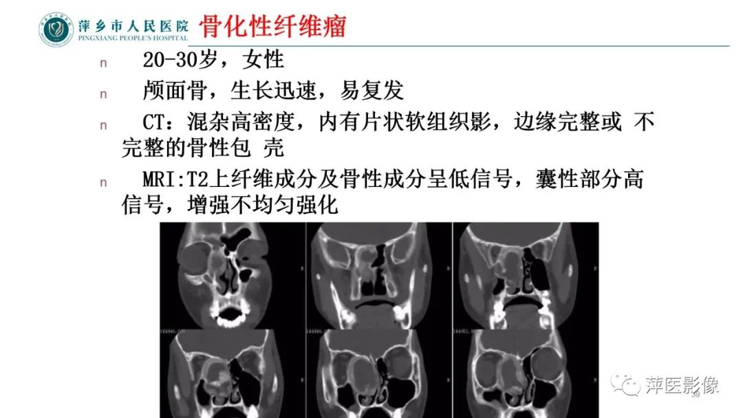 影像PPT - 【PPT】鼻/鼻窦病变影像诊断-39
