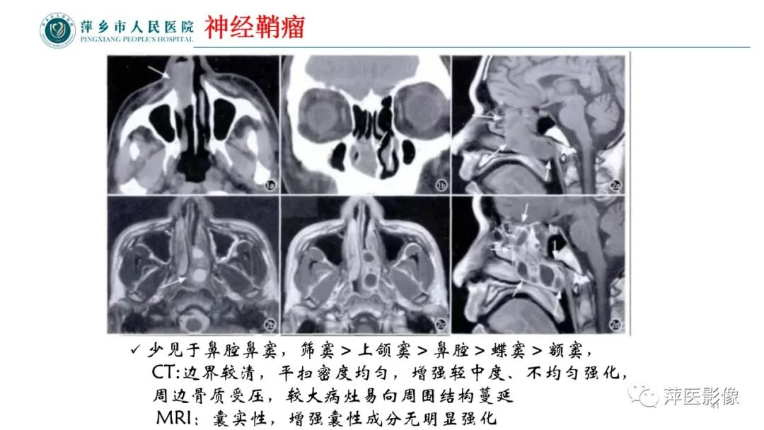 影像PPT - 【PPT】鼻/鼻窦病变影像诊断-41