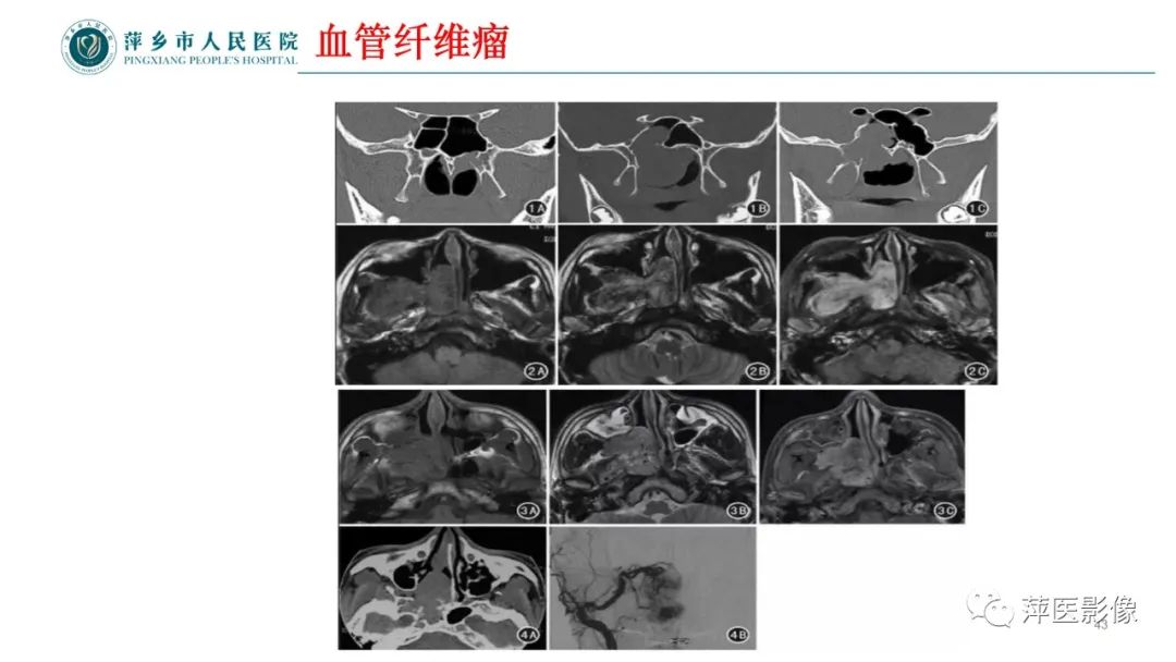 影像PPT - 【PPT】鼻/鼻窦病变影像诊断-43