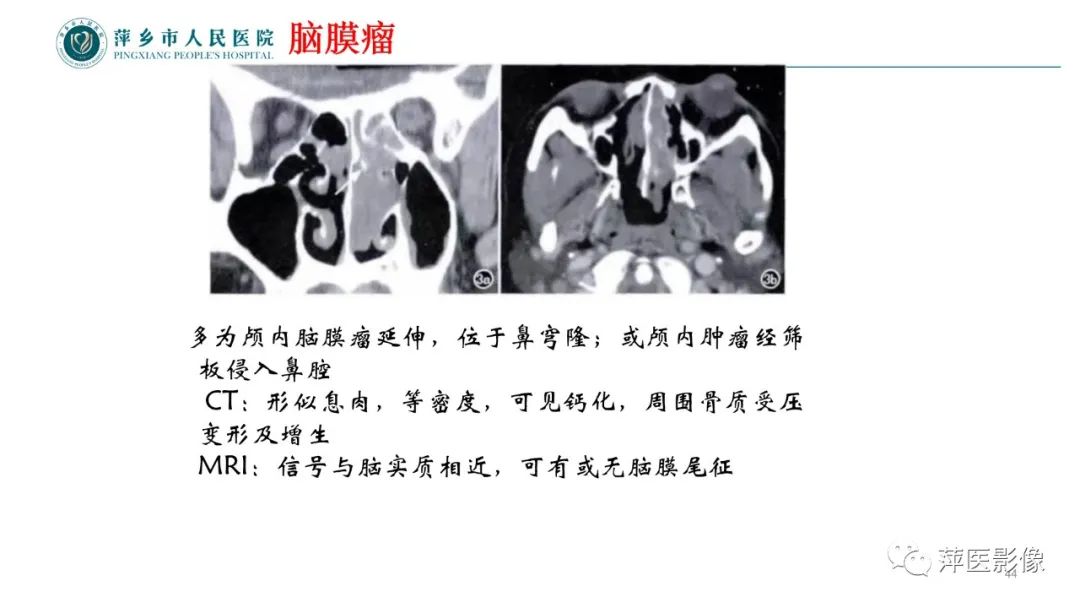 影像PPT - 【PPT】鼻/鼻窦病变影像诊断-44