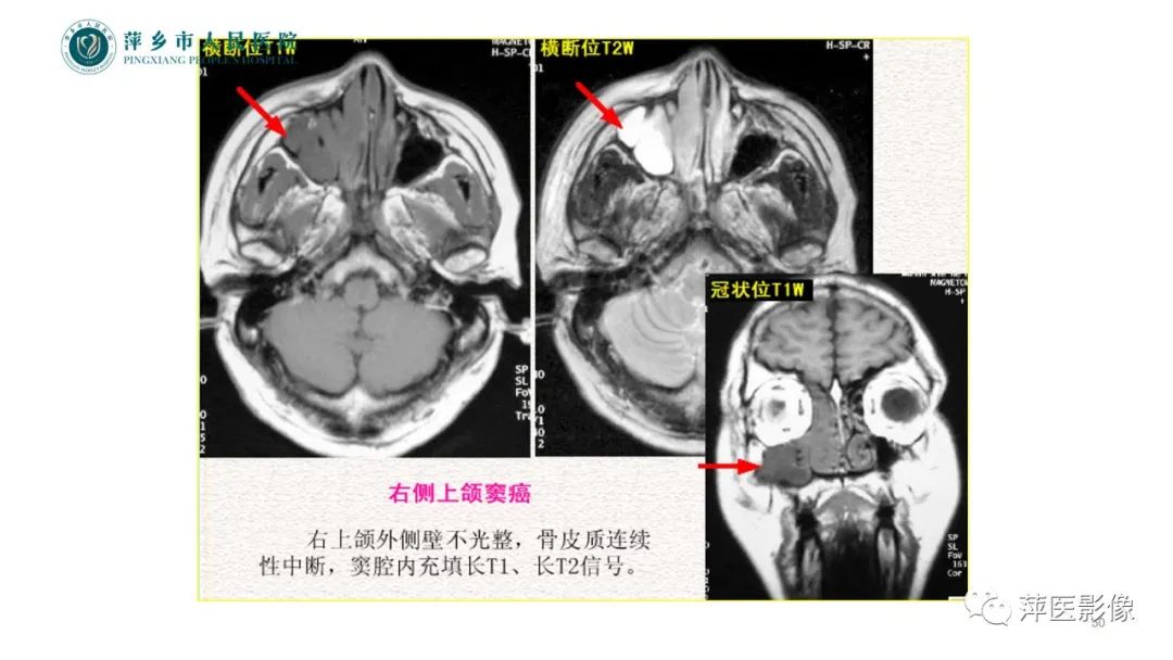 影像PPT - 【PPT】鼻/鼻窦病变影像诊断-50
