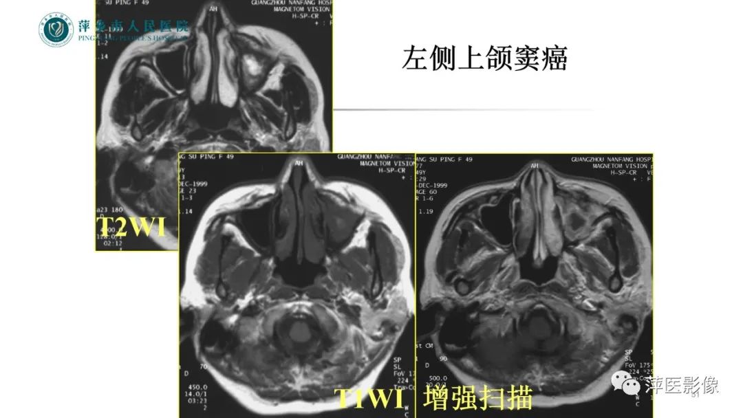 影像PPT - 【PPT】鼻/鼻窦病变影像诊断-51