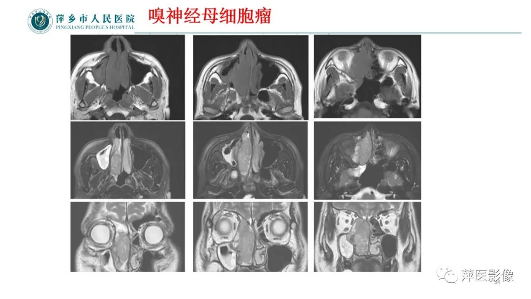 影像PPT - 【PPT】鼻/鼻窦病变影像诊断-54