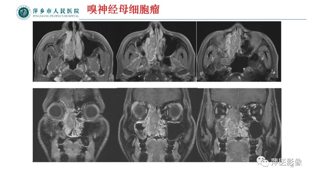 影像PPT - 【PPT】鼻/鼻窦病变影像诊断-55