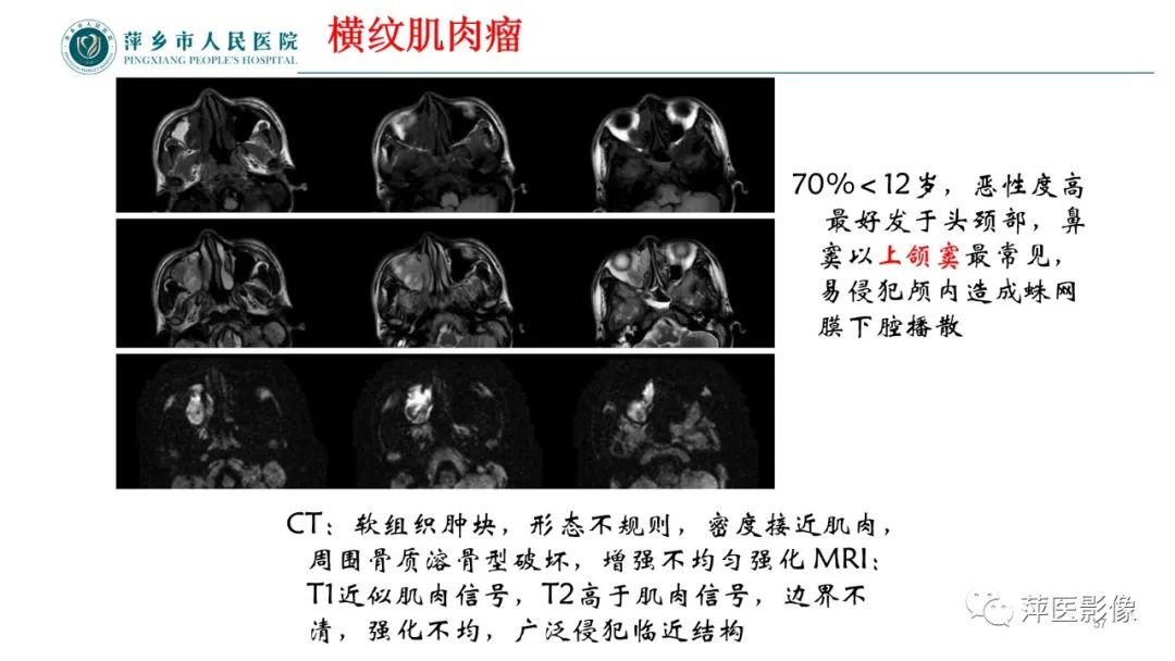影像PPT - 【PPT】鼻/鼻窦病变影像诊断-57