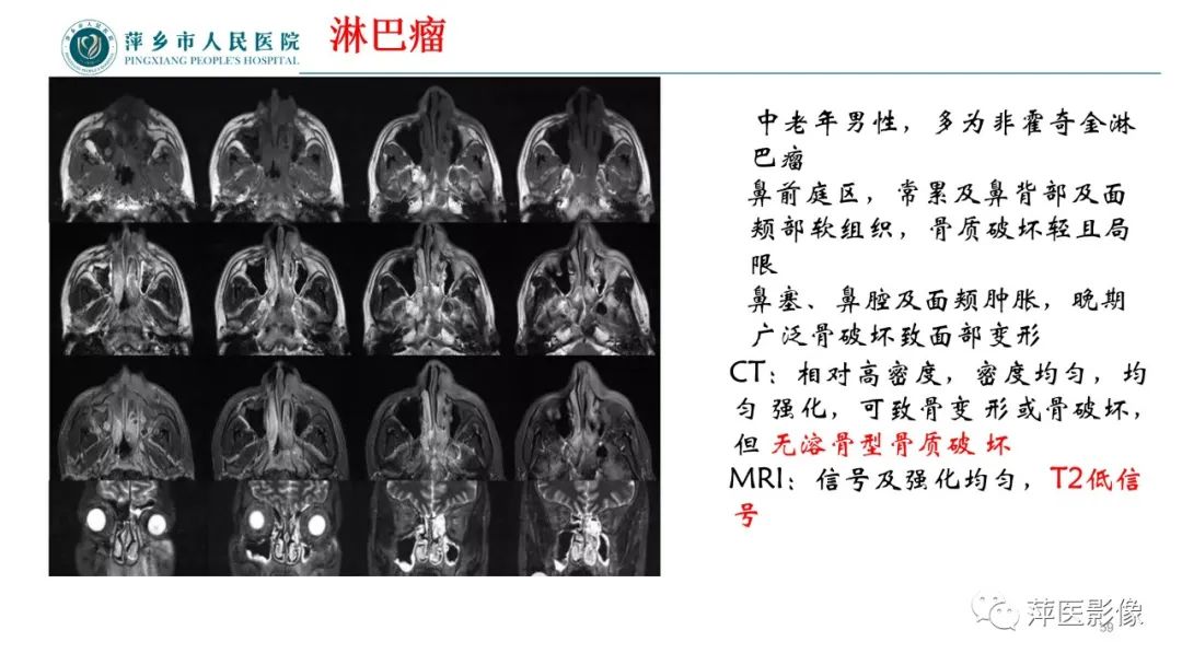 影像PPT - 【PPT】鼻/鼻窦病变影像诊断-59