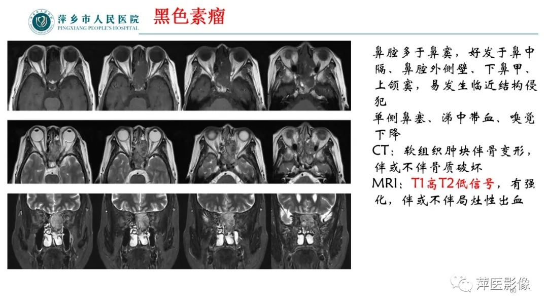 影像PPT - 【PPT】鼻/鼻窦病变影像诊断-60