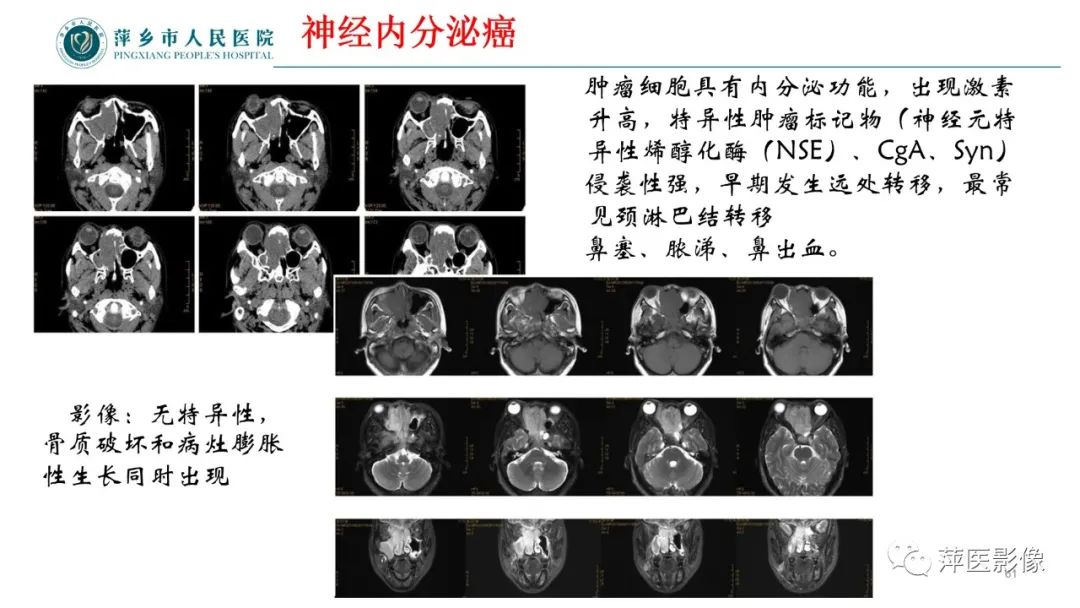 影像PPT - 【PPT】鼻/鼻窦病变影像诊断-61