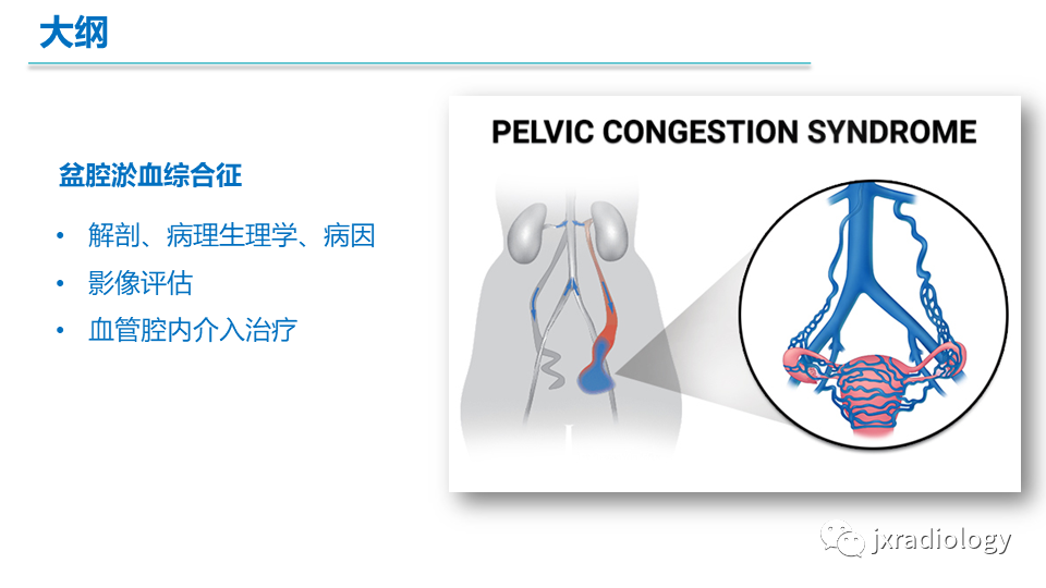 影像PPT - 【PPT】盆腔静脉淤血综合征：检查、分级及血管内治疗-3