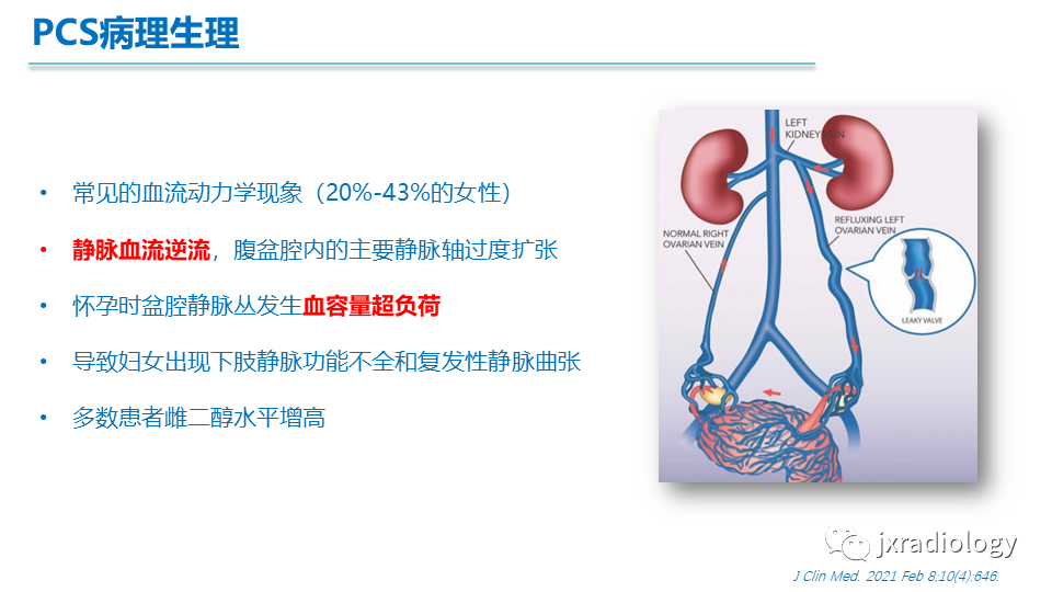 影像PPT - 【PPT】盆腔静脉淤血综合征：检查、分级及血管内治疗-6