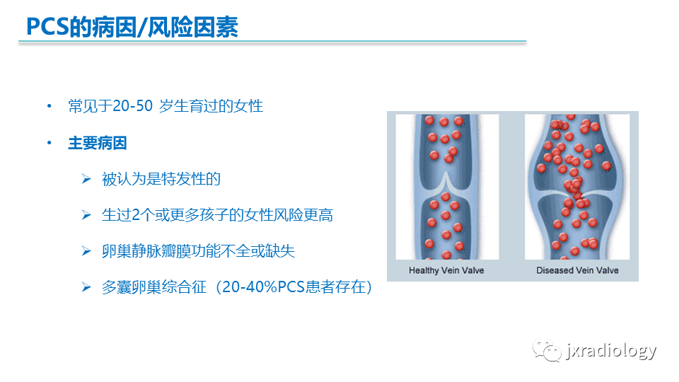影像PPT - 【PPT】盆腔静脉淤血综合征：检查、分级及血管内治疗-8