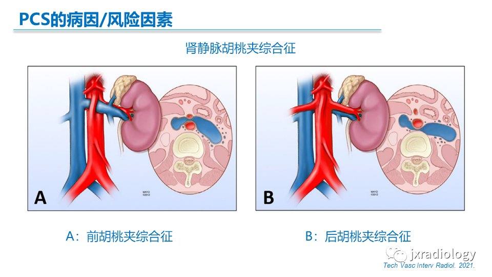 影像PPT - 【PPT】盆腔静脉淤血综合征：检查、分级及血管内治疗-10
