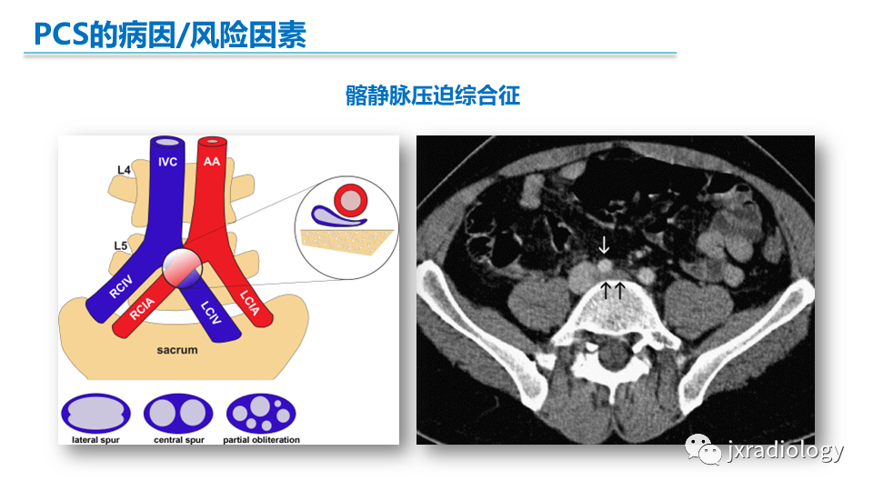 影像PPT - 【PPT】盆腔静脉淤血综合征：检查、分级及血管内治疗-12