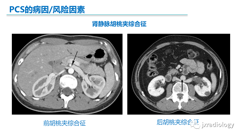 影像PPT - 【PPT】盆腔静脉淤血综合征：检查、分级及血管内治疗-11