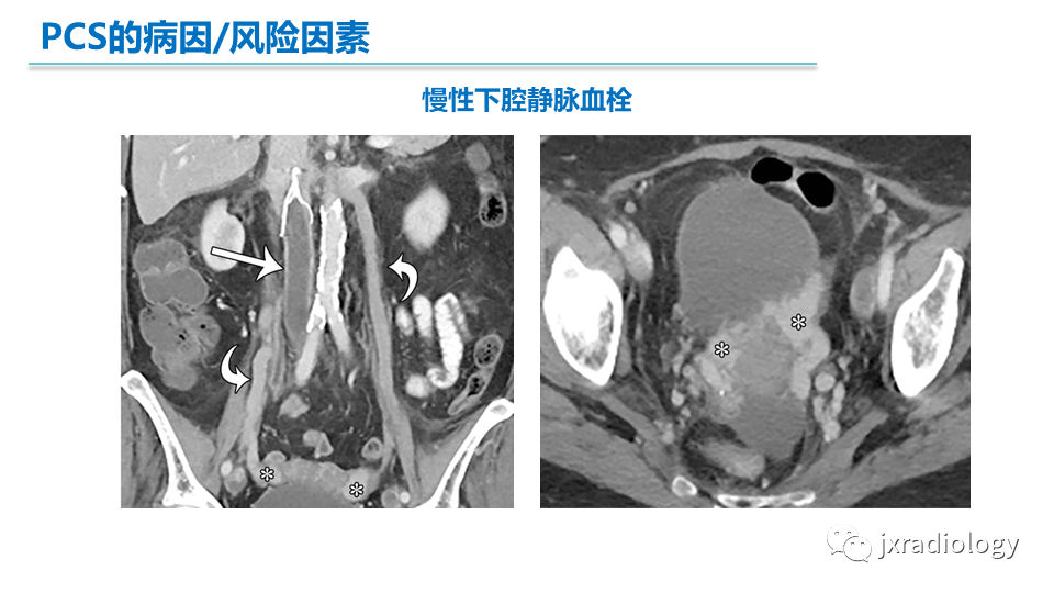 影像PPT - 【PPT】盆腔静脉淤血综合征：检查、分级及血管内治疗-14