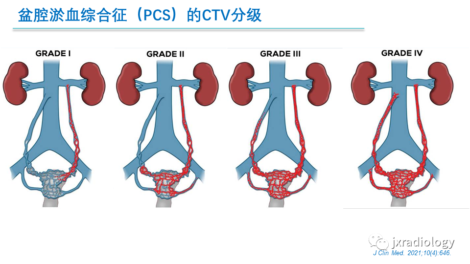 影像PPT - 【PPT】盆腔静脉淤血综合征：检查、分级及血管内治疗-18