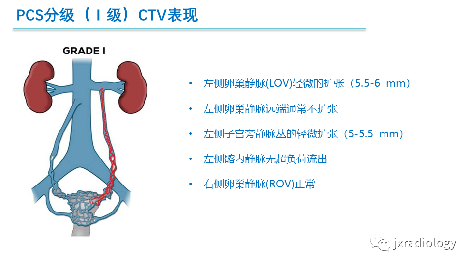 影像PPT - 【PPT】盆腔静脉淤血综合征：检查、分级及血管内治疗-19