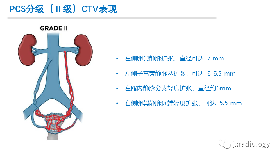 影像PPT - 【PPT】盆腔静脉淤血综合征：检查、分级及血管内治疗-21