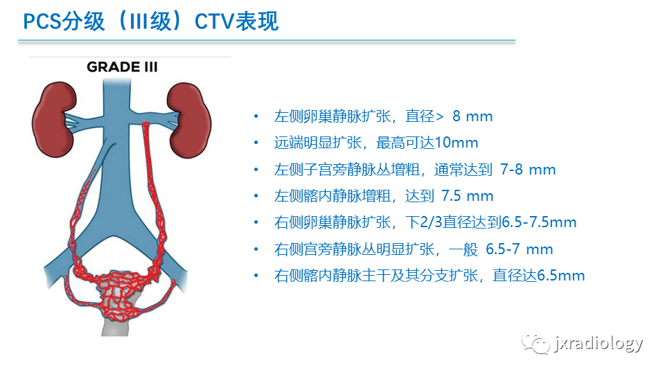 影像PPT - 【PPT】盆腔静脉淤血综合征：检查、分级及血管内治疗-24