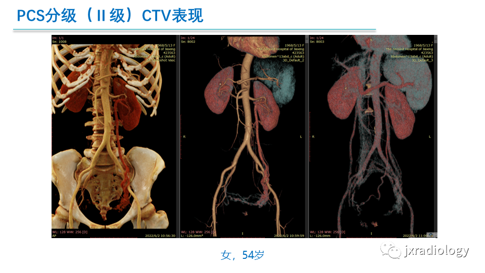 影像PPT - 【PPT】盆腔静脉淤血综合征：检查、分级及血管内治疗-23