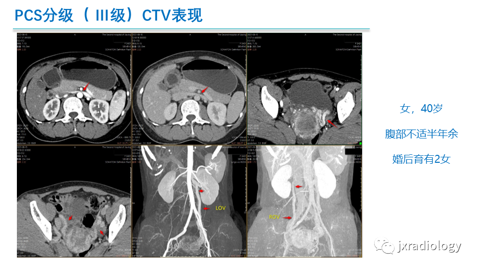 影像PPT - 【PPT】盆腔静脉淤血综合征：检查、分级及血管内治疗-26
