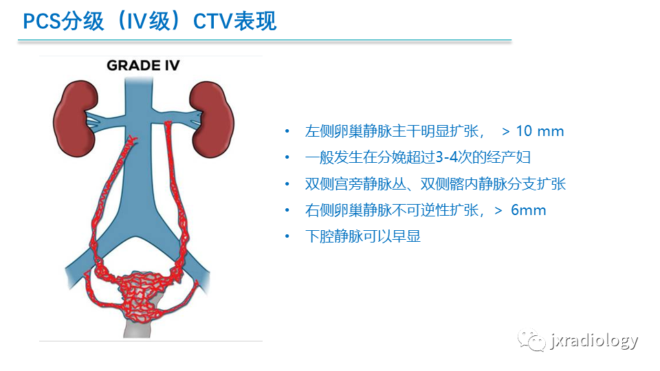 影像PPT - 【PPT】盆腔静脉淤血综合征：检查、分级及血管内治疗-28