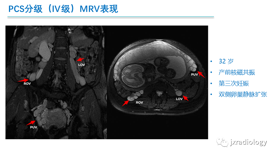 影像PPT - 【PPT】盆腔静脉淤血综合征：检查、分级及血管内治疗-30