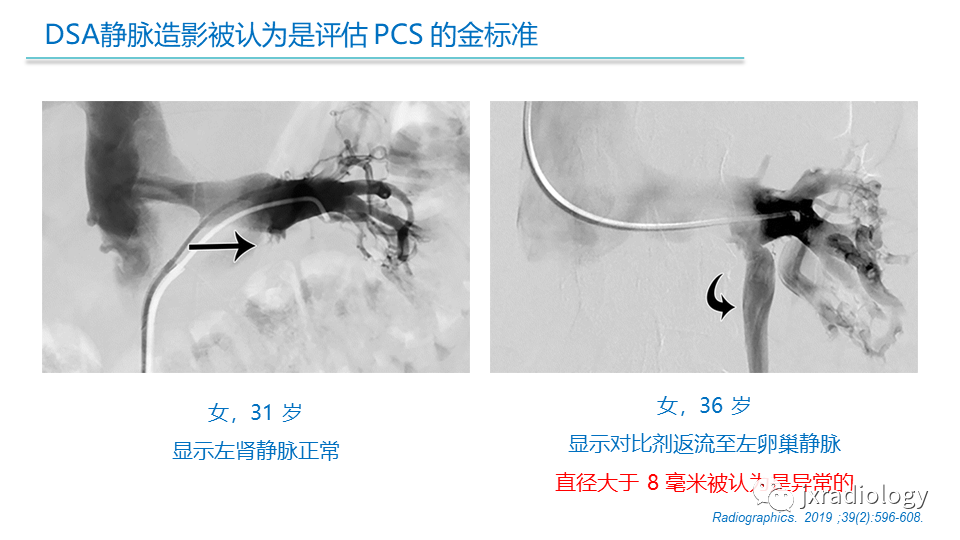影像PPT - 【PPT】盆腔静脉淤血综合征：检查、分级及血管内治疗-31