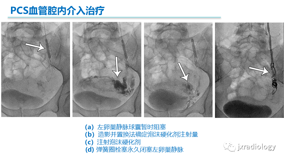影像PPT - 【PPT】盆腔静脉淤血综合征：检查、分级及血管内治疗-35