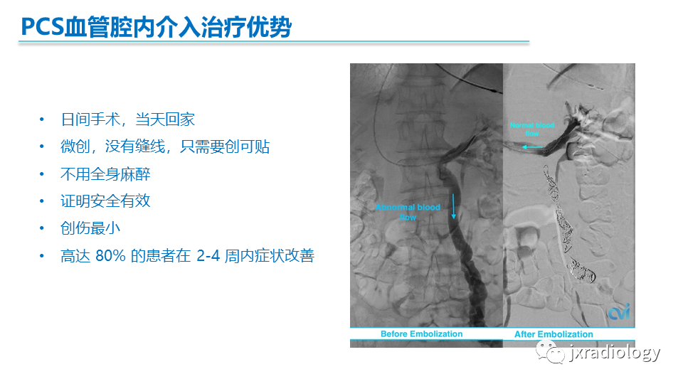 影像PPT - 【PPT】盆腔静脉淤血综合征：检查、分级及血管内治疗-37