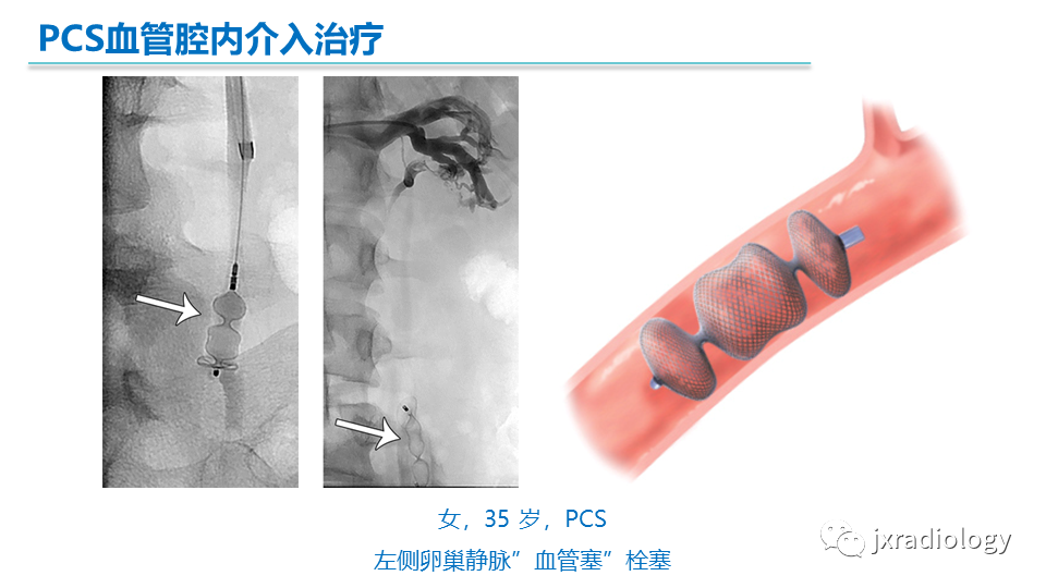 影像PPT - 【PPT】盆腔静脉淤血综合征：检查、分级及血管内治疗-36