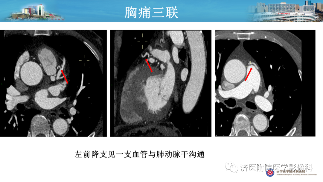 影像PPT - 【PPT】冠状动脉瘘的影像诊断-3