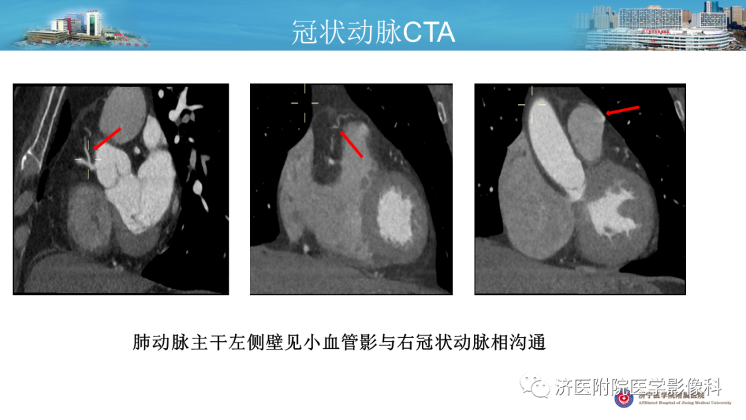 影像PPT - 【PPT】冠状动脉瘘的影像诊断-11