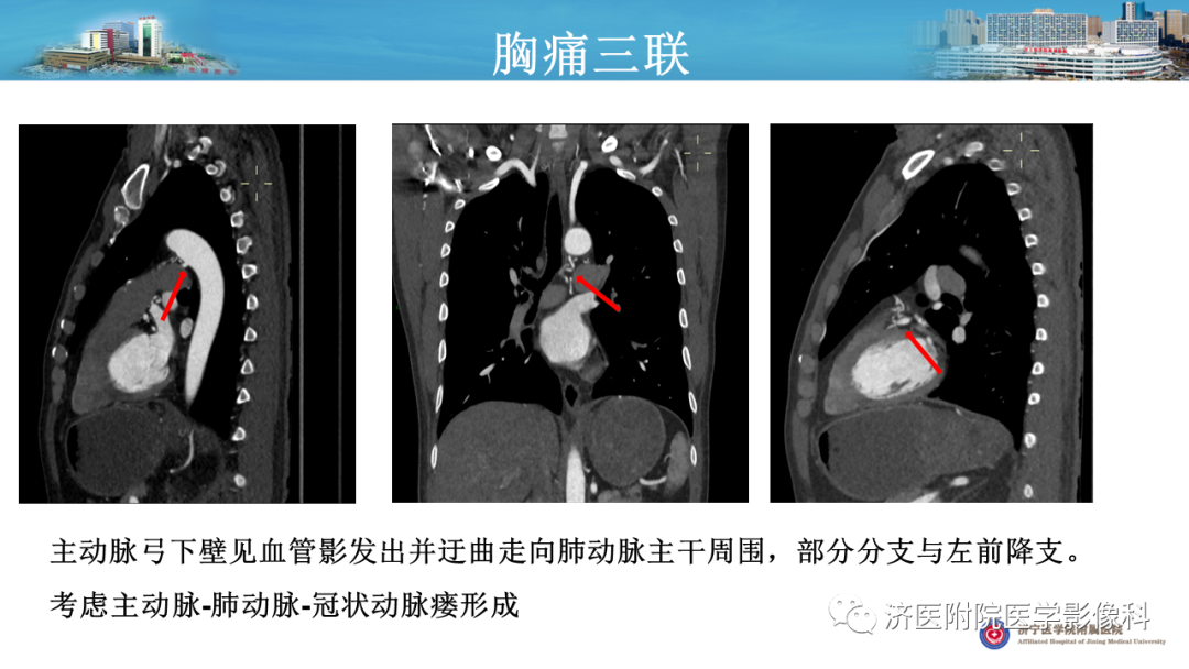 影像PPT - 【PPT】冠状动脉瘘的影像诊断-13