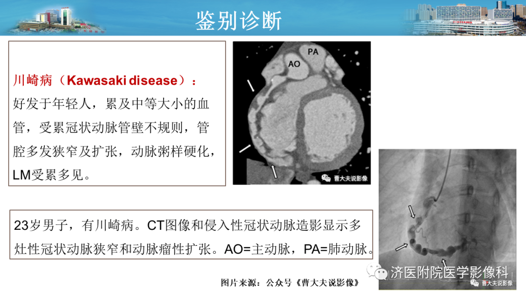 影像PPT - 【PPT】冠状动脉瘘的影像诊断-14