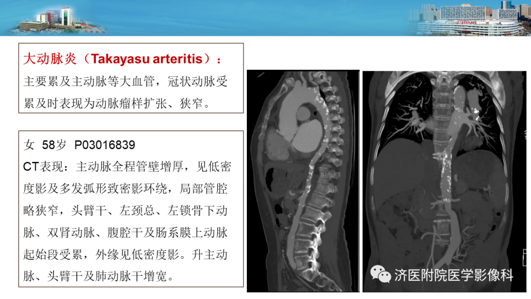 影像PPT - 【PPT】冠状动脉瘘的影像诊断-15