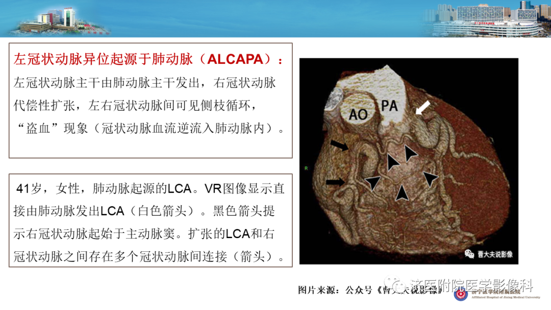 影像PPT - 【PPT】冠状动脉瘘的影像诊断-16